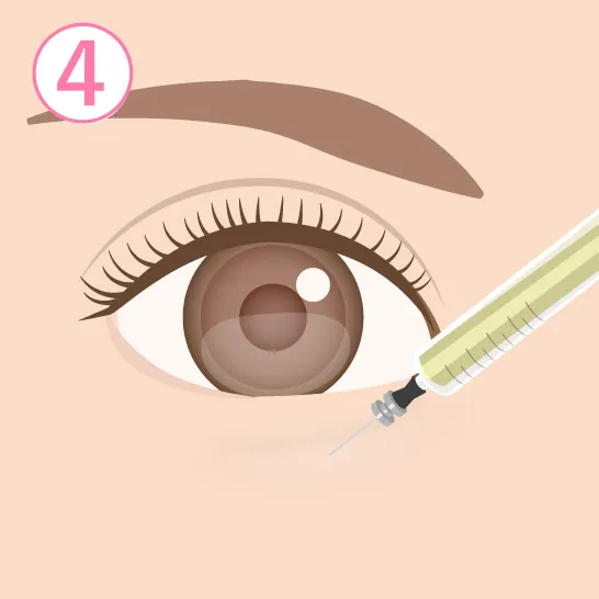 眼窩脂肪除去イメージ04