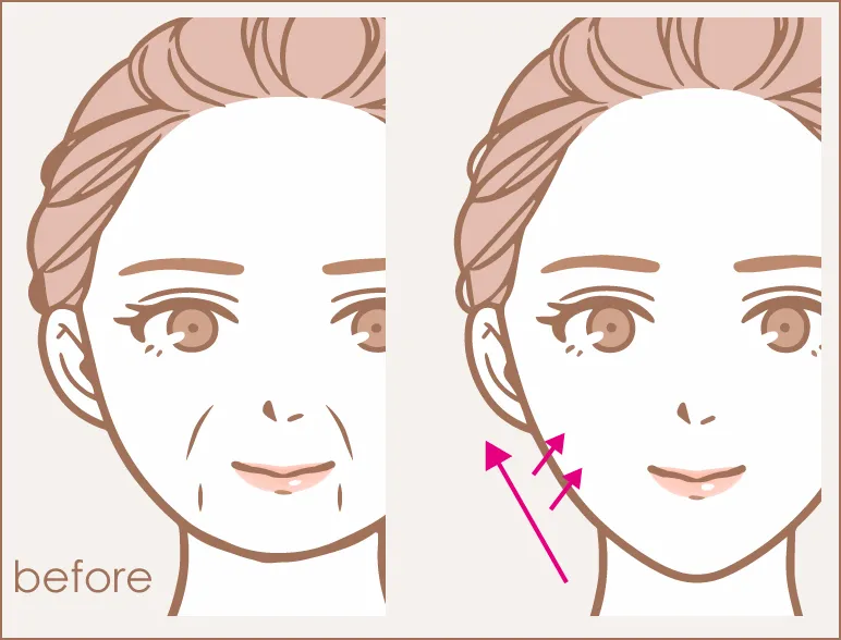 皮膚引き上げ施術イラスト