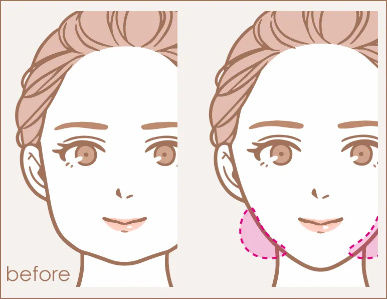 エラ張りイラスト