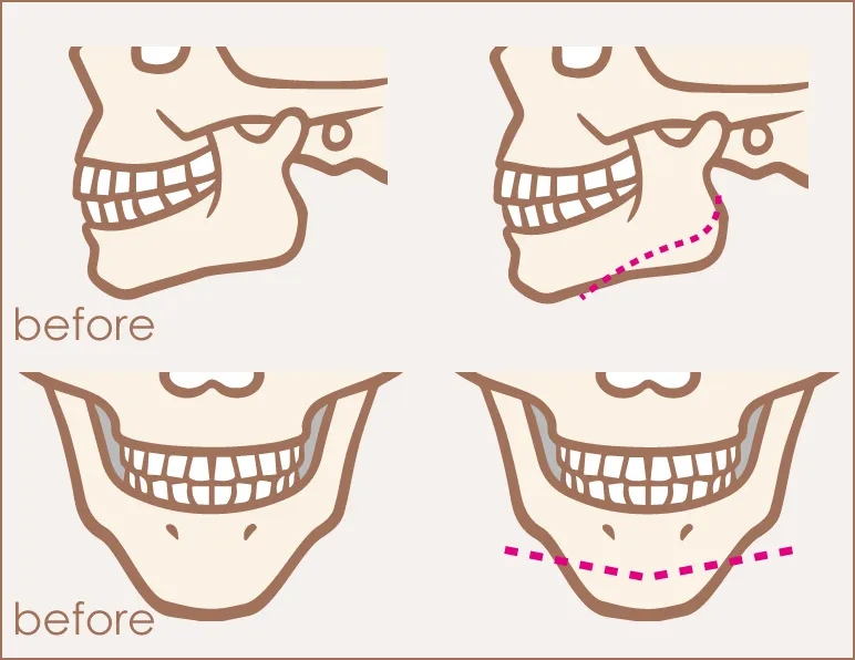 骨切整形イラスト