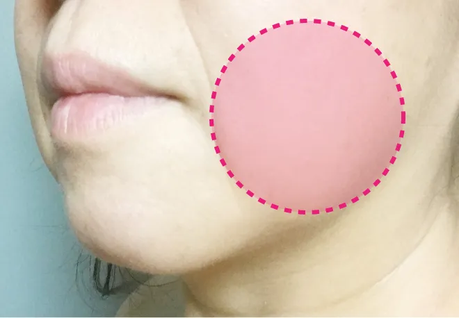 バッカルファットイメージ画像