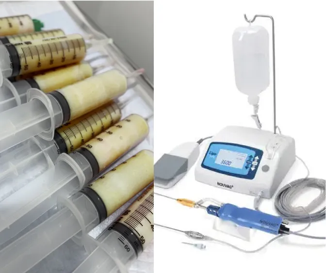 脂肪吸引したシリンジと電動式吸引器