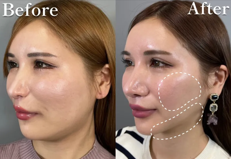 顔の脂肪吸引症例