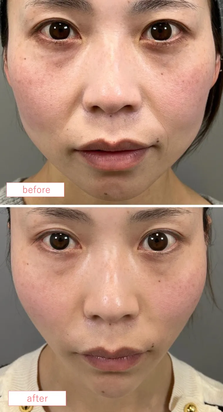 脂肪吸引糸リフト複合施術症例