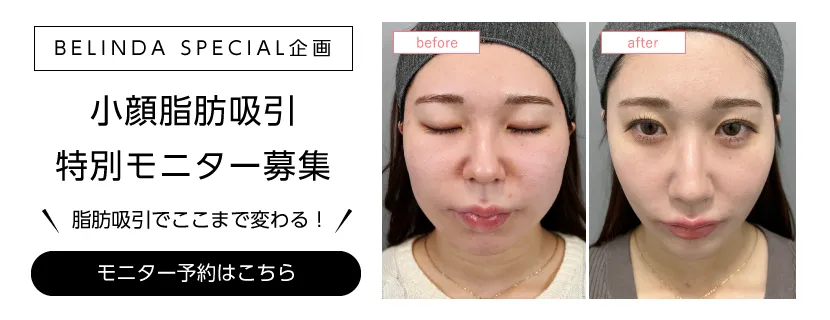小顔脂肪吸引モニター