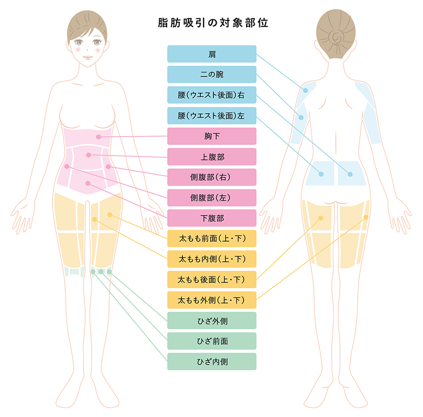 脂肪吸引の対象部位イメージ