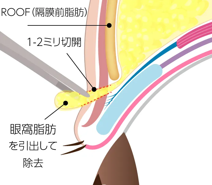 目元全体に重さを与えている眼窩脂肪の図解