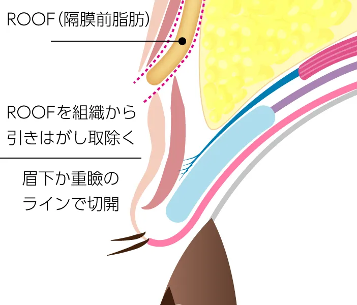 まぶた・眉下に厚みを与えるROOF(隔膜前脂肪)