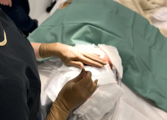 まぶたの脂肪取り切開施術中