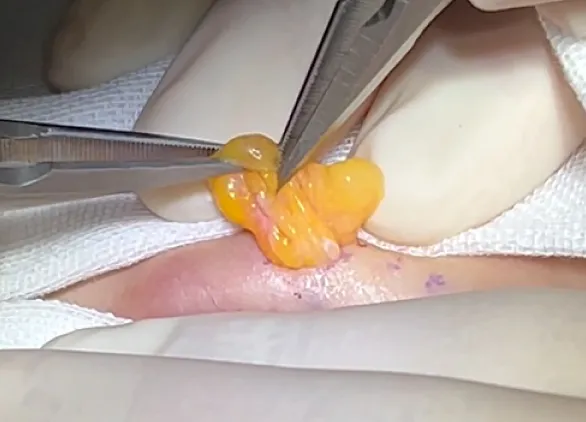 取り除かれた眼窩脂肪