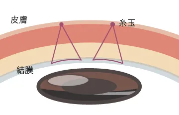 スタンダード2点留め2本法