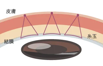 アムール・トレ3点留め3本法
