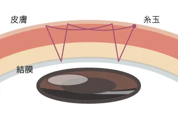 ティナライン・線止め留法