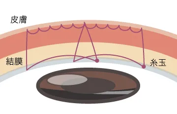 ブリリアント・モア/スクエア裏留シークレットダブル法