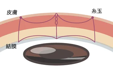 フォルテ・スクエア裏留シークレット法