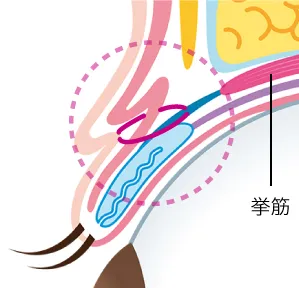 二重術挙筋法イメージ