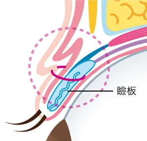 二重術挙筋法イメージ