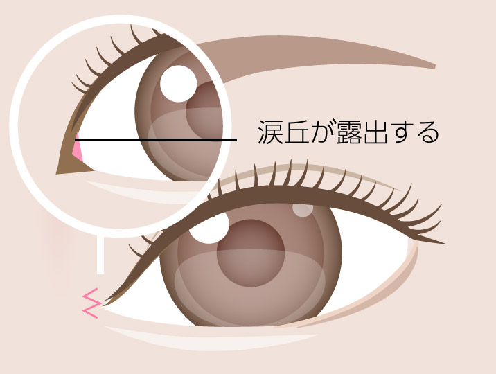 イメージ_目頭切開箇所
