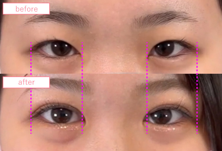 目頭切開の症例写真_01