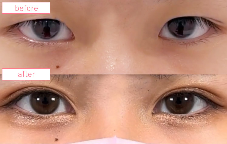 目頭切開の症例写真_02