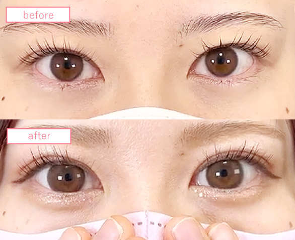 目頭切開の症例写真_蒙古襞あり末広型二重