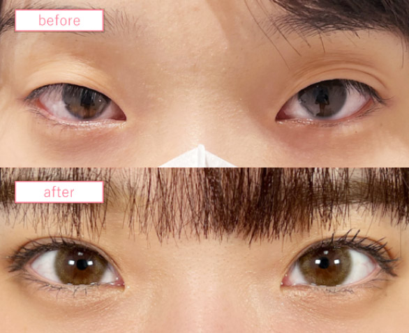 目頭切開の症例写真_蒙古襞ありMIX二重