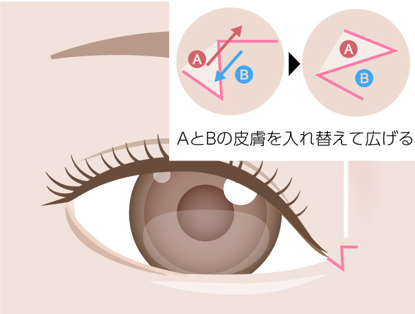 イメージ_Z法切開