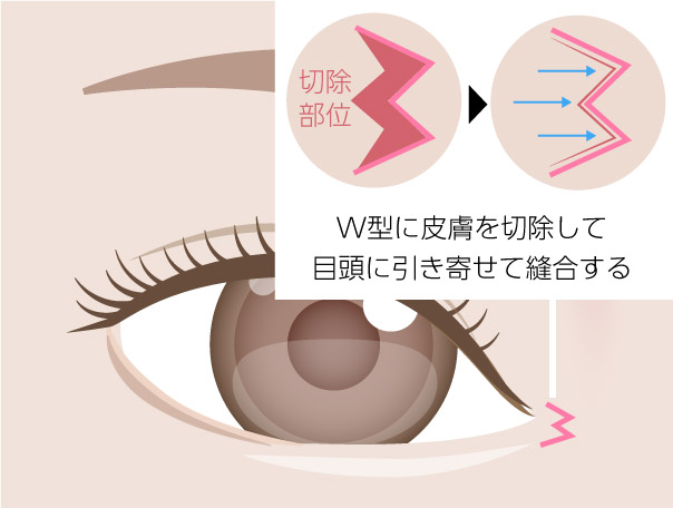 イメージ_W法切開