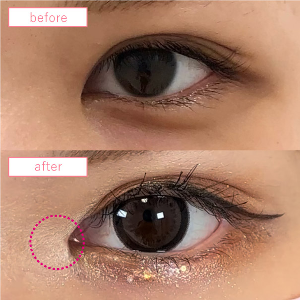 目頭切開の症例写真_03