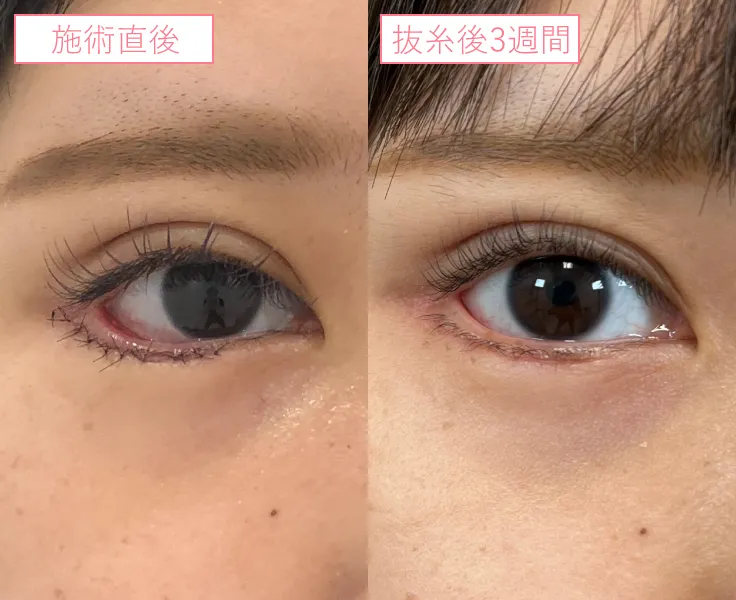 グラマラスラインビフォーアフターcase01