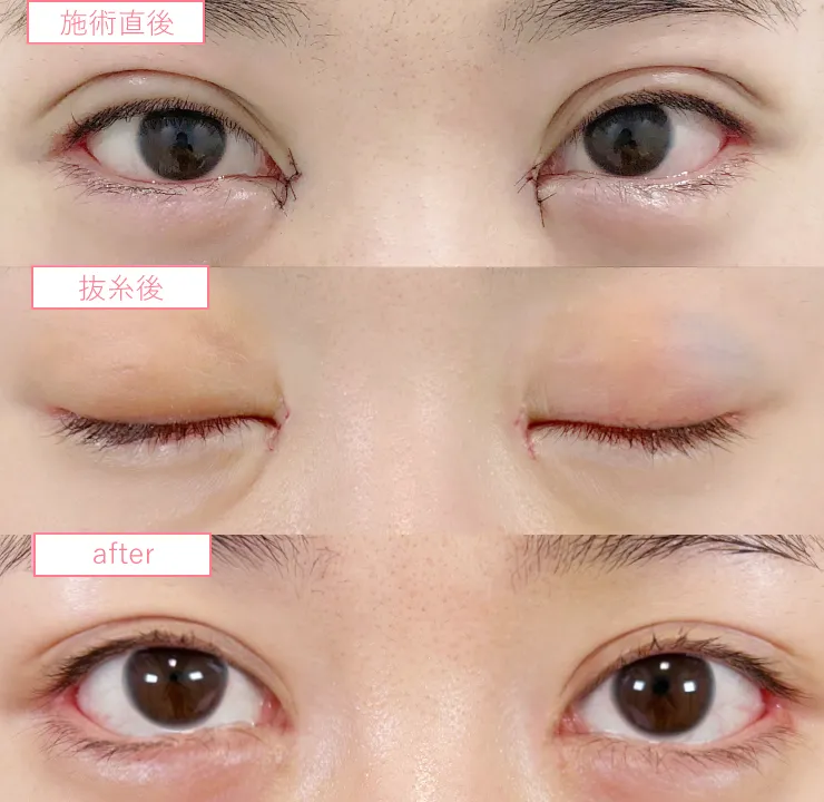 目頭切開ビフォーアフターcase01