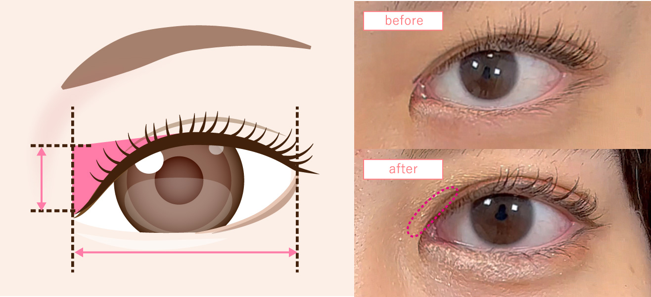 目上切開|切開部位と変化の違いのイメージ