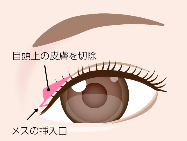 切開と縫合のイメージ
