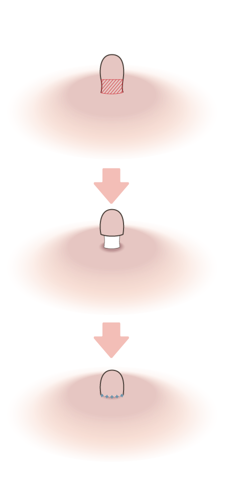 乳頭縮小術・乳管温存法×長さ縮小施術方法イメージ