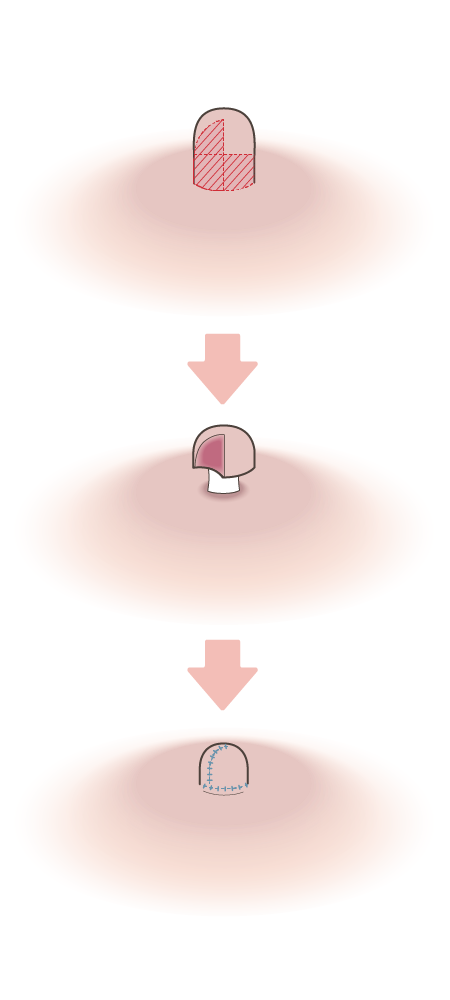 乳頭縮小術・乳管温存法×長さ円周縮小施術方法イメージ