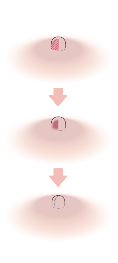 乳頭縮小術・乳管温存法×円周縮小施術方法イメージ