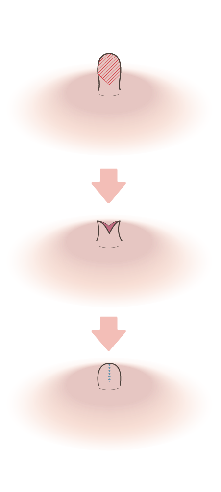 乳管温存法なし(単純切開法)術方法イメージ