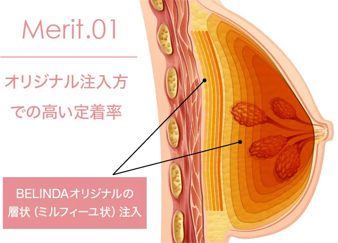 豊胸術・層状注入法