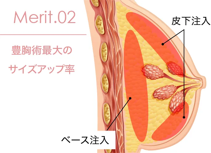 豊胸術・皮下注入法