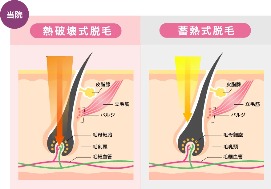 熱破壊式脱毛と蓄熱脱毛のイメージイラスト