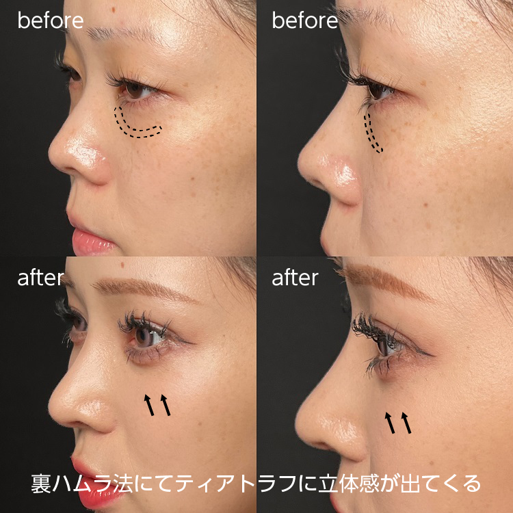 裏ハムラ法のメリット