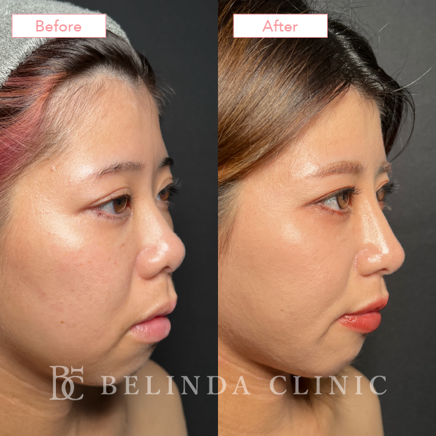 鼻プロテーゼのみ症例