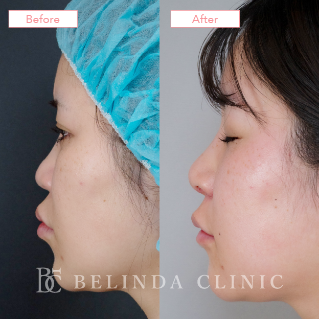 鼻プロテーゼのみ症例