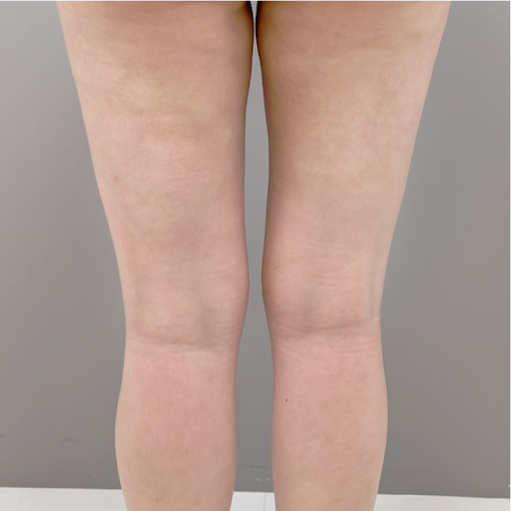 脂肪豊胸太もも脂肪吸引2週間後