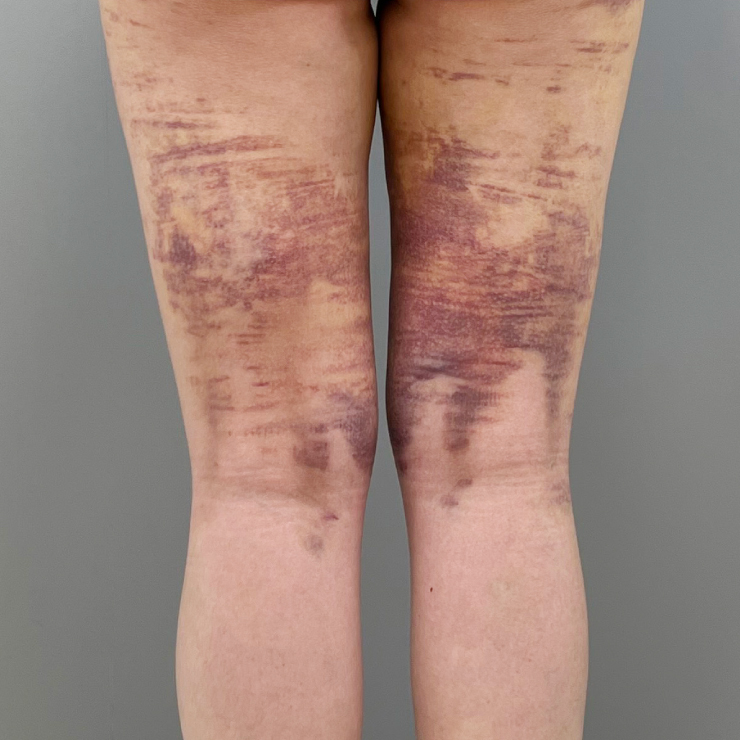 脂肪豊胸ダウンタイムイメージ