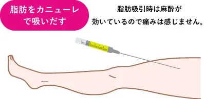 脂肪をカニューレで吸いだす