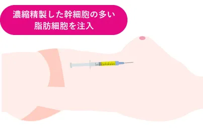 濃縮精製した幹細胞の多い脂肪細胞を注入