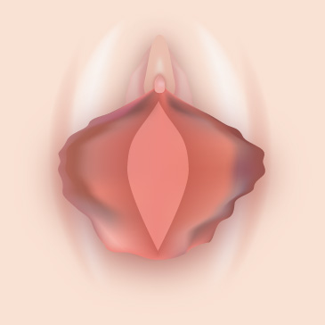 小陰唇が大きい・黒ずみありイメージ