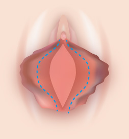 小陰唇肥大黒ずみ型