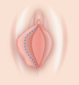 小陰唇片側肥大型